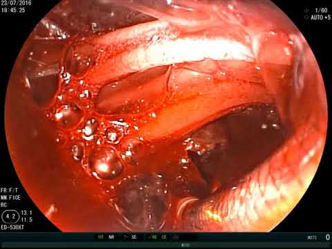 Video: Kesan Jangka Panjang Stent Eluting 6-mercaptopurine Dalam Arteri Koronari Porcine