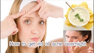 How To Remove The Pimples Overnight | Acne Treatment | By Health And Fitness Channel