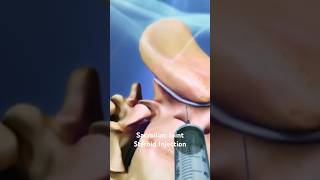 Sacroiliac Joint Steroid Injection