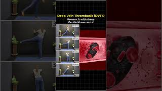 Yoga for Deep Vein Thrombosis DVT #dvt #ytshorts #shorts