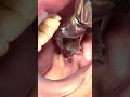 ASMR 抜歯音 ASMR 抜歯音
