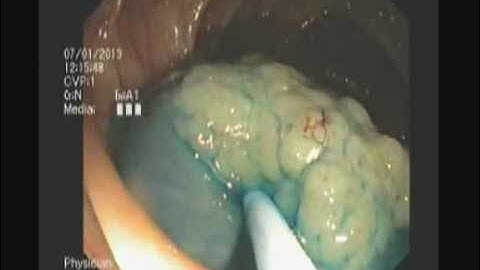 Polypectomy Colon - Ascentic Colon Granular LST - EMR - APC - STEFANOS DOKAS - The ERCP Channel