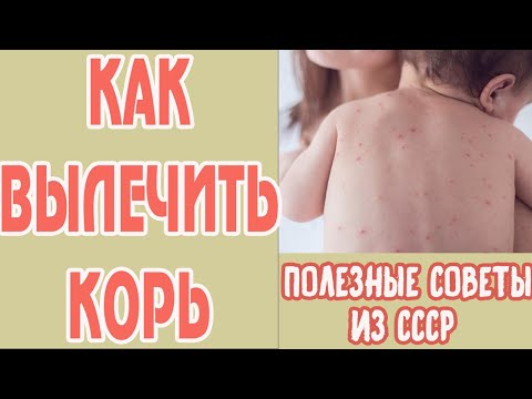Как лечить корь у детей в домашних условиях. Корь симптомы. Лечение кори у ребенка. Советы из СССР
