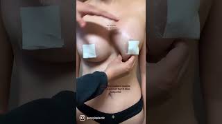 How to massage after Breast Augmentation?