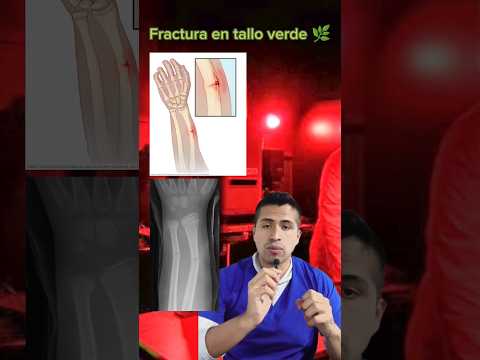 Video: ¿Cuándo ocurre una fractura en tallo verde?