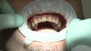 MAKEOVER 3 - Dr. Štimac centar stomatologije