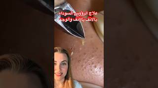 علاج الرؤوس السوداء بالانف والوجه الرؤوس_السوداء علاج بشرة skincare fypシ dubai