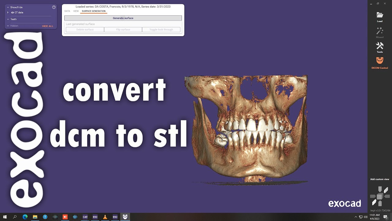 Convert Dicom CT to STL files - YouTube