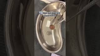Dental Hack : Prevent Mirror Fogging During Dental Scaling! || Oxy Dental