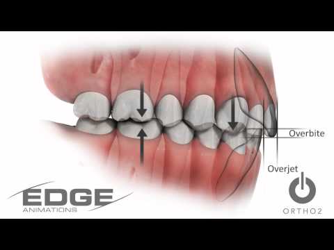 Normal Occlusion