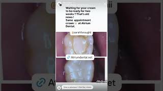 One day crown! No more temporary 🦷 #phoenix #phoenixdentist  #atriumdental #smilemakeover