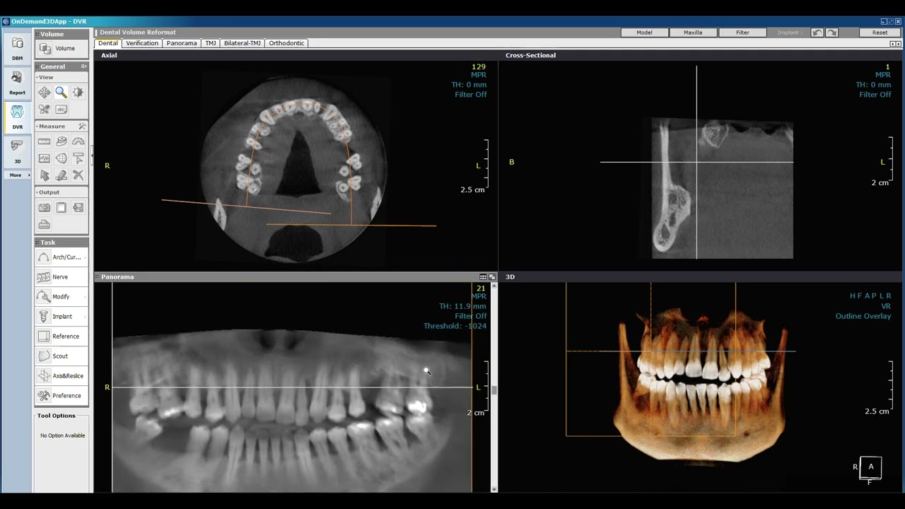 Часть 2, Программное обеспечение для 3D КТ по ​​запросу, Построение дуги зуба, Автор: д-р Халед Э...