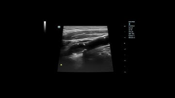Occluded internal carotid artery Ultrasound Image and Video #shortsvideo