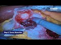 Robotic Partial Nephrectomy Training Simulator | ALDAVER Surgical Model