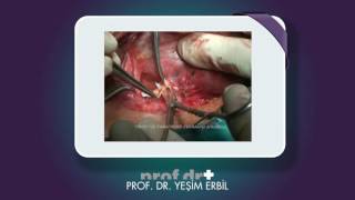 Finding nerves in thyroid surgery