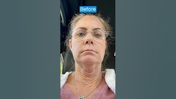INCREDIBLE Facelift Transformation! NECK LIFT RESTORE