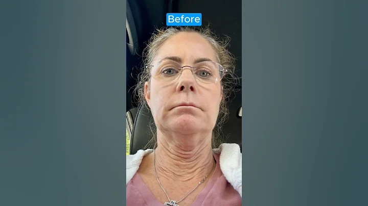 INCREDIBLE Facelift Transformation! NECK LIFT RESTORE
