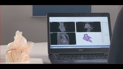 MIMICS INNOVATION SUITE 21 | Benefits for Cardiovascular Applications in This New Release