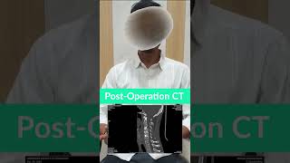 ಬೈಕ್ ಅಪಘಾತದ ನಂತರ ಮತ್ತೆ ನಡೆದ ರೋಗಿ 😔🏍️ | ಯಶಸ್ವಿ Spine Surgery Story 💙
