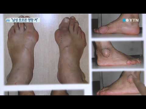바람만 스쳐도 아프다는 '통풍' 남성이 10배 / YTN
