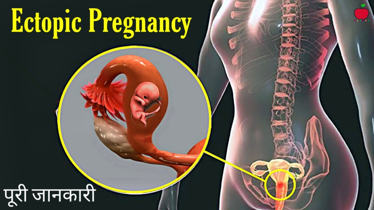 Ectopic Pregnancy के लक्षण और कारण क्या है,इसके लक्षण कब दिखने शुरू होते है । Hindi,Urdu - YouTube