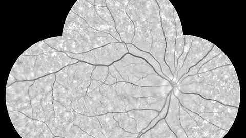 Demo video of processing fundus images