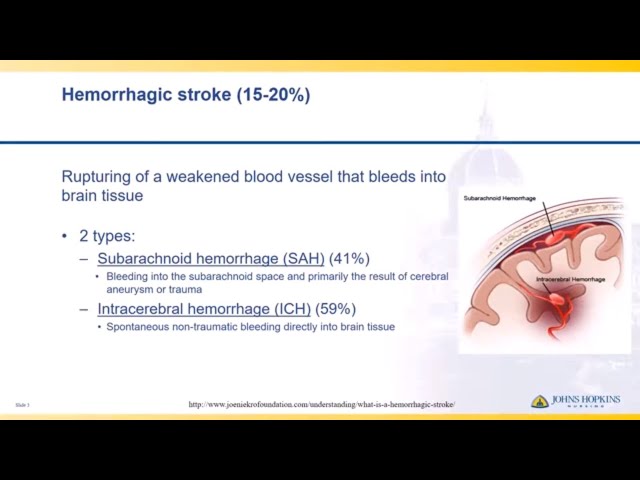 Hemorrhagic Stroke | Lisa Klein class=