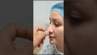 Stunning Rhinoplasty Transformation by Dr. Rivera💕-Vive Plastic Surgery ✨ in #tijuana