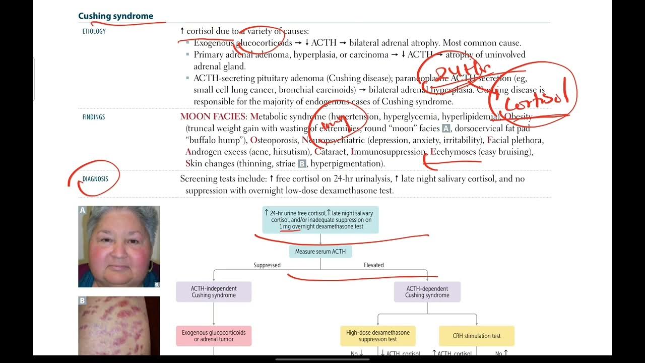 Cushing Syndrome Endocrinology 19 First Aid in Urdu/Hindi YouTube