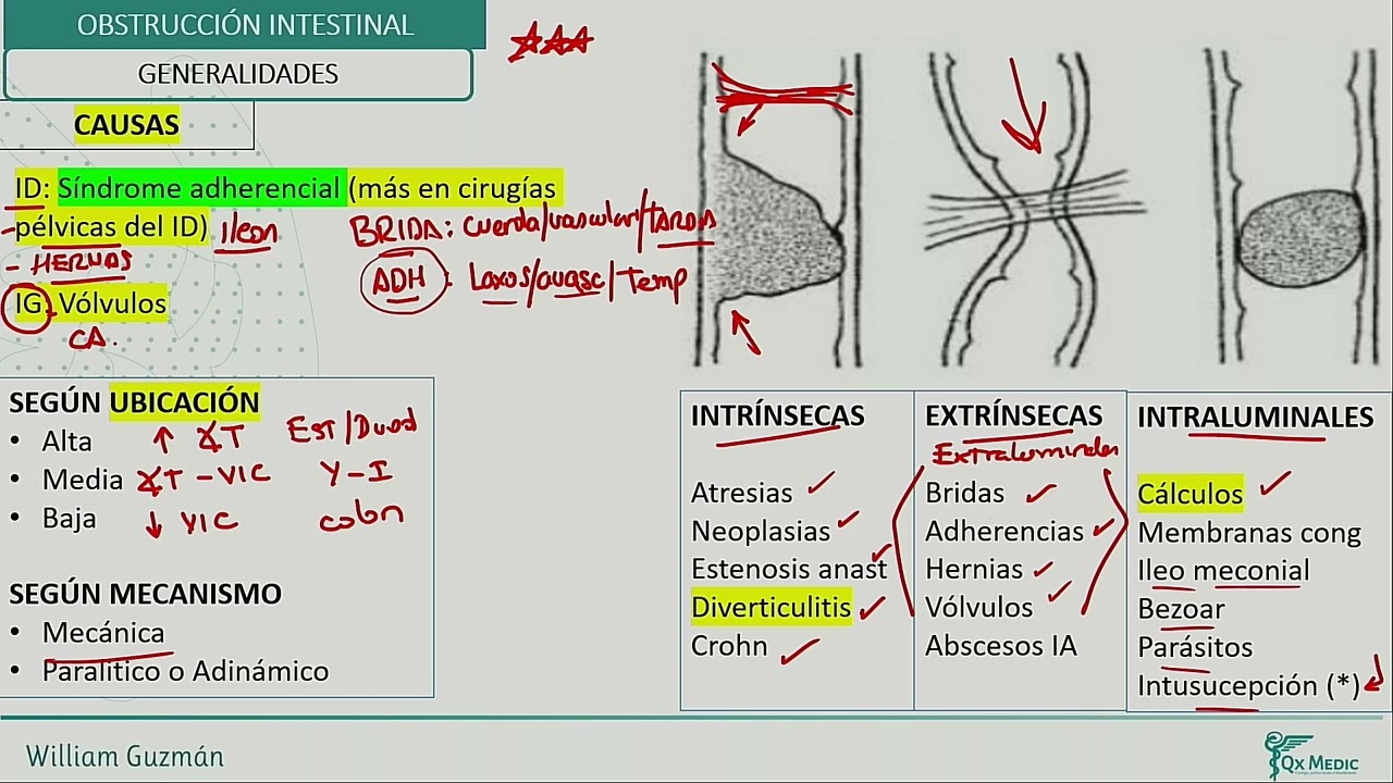 Dieta para obstrucción intestinal