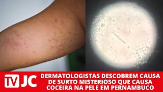 Dermatologistas descobrem causa de surto de coceira em Pernambuco