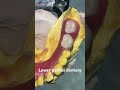 Lower partial denture 😬😬😬#splittooth #apexdental #orthodontist #dentistry #partialdenture