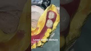 Lower partial denture 😬😬😬#splittooth #apexdental #orthodontist #dentistry #partialdenture