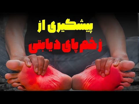 راز پیشگیری از زخم پای دیابتی فقط با سی ثانیه ای پاهات رو نجات بده