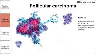 Thyroid Cancers