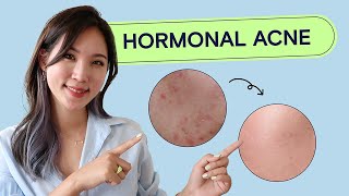 How To Treat Hormonal Acne | Acne School EP03 Health