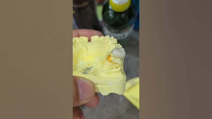 Dental crown after Root Canal Treatment #medical #bodyfacts #foryoupage #doctoraafi #fyp