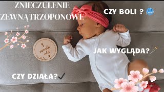 ZNIECZULENIE ZEWNĄTRZOPONOWE 🩼| CZY DZIAŁA?| JAK WYGLĄDA ?| VLOG