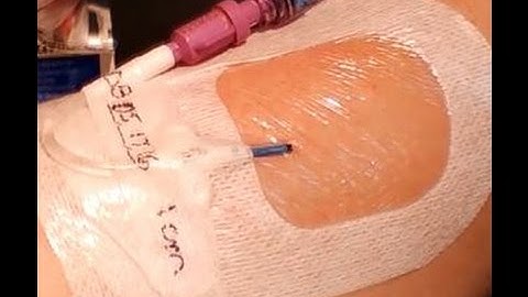 PICC Dressing Change: Tegaderm™ I.V. Advanced