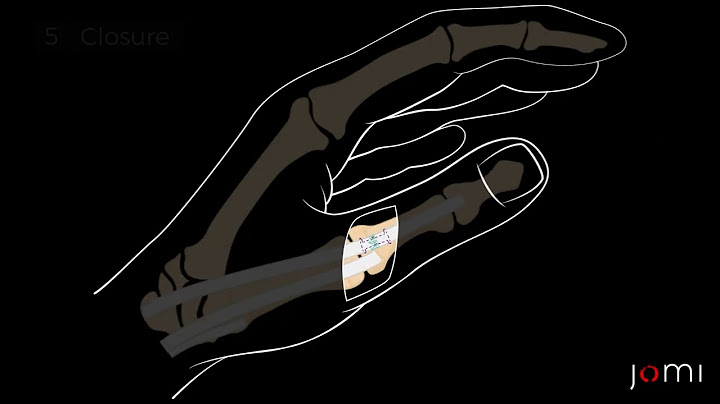 Thumb Extensor Tendon Laceration Repair