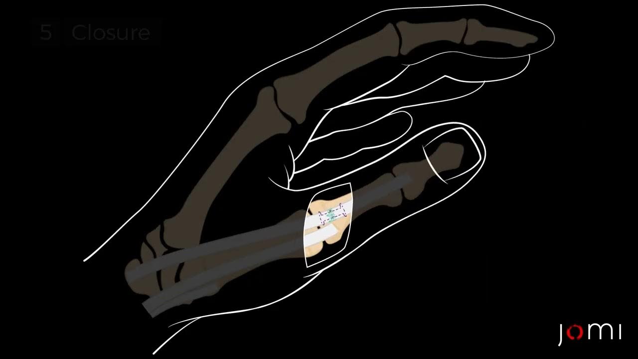 thumb-extensor-tendon-laceration-repair-youtube