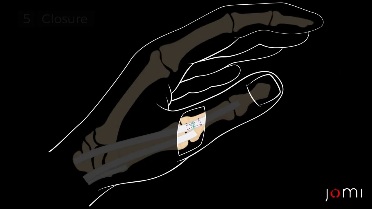 Thumb Extensor Tendon Laceration Repair YouTube Thumb Extensor Tendon Laceration Repair YouTube