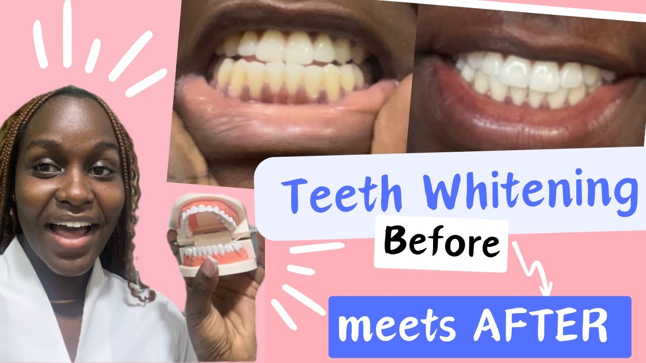 Getting my Teeth Whitened at The Dentist👩🏾‍⚕️CRYSTAL SPECIALIST