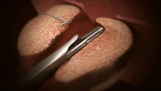 UroLift Animation Video
