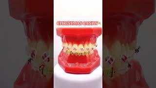 Holiday Braces Inspo✨🎄 #shorts