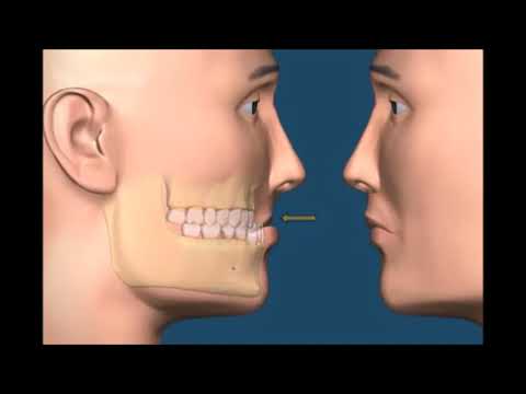 Неправильный прикусы и аномалия прикуса  Стоматология