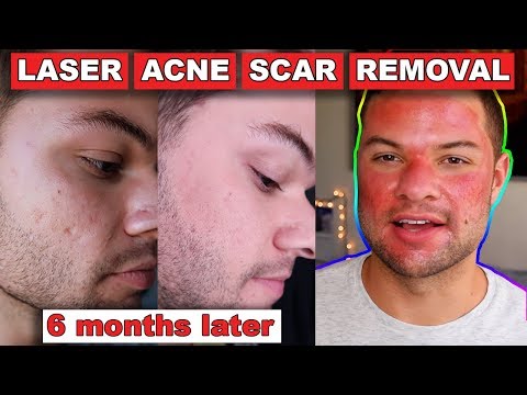 Acne Scar Removal Before And After  Months:  Fractional C Laser Skin Resurfacing