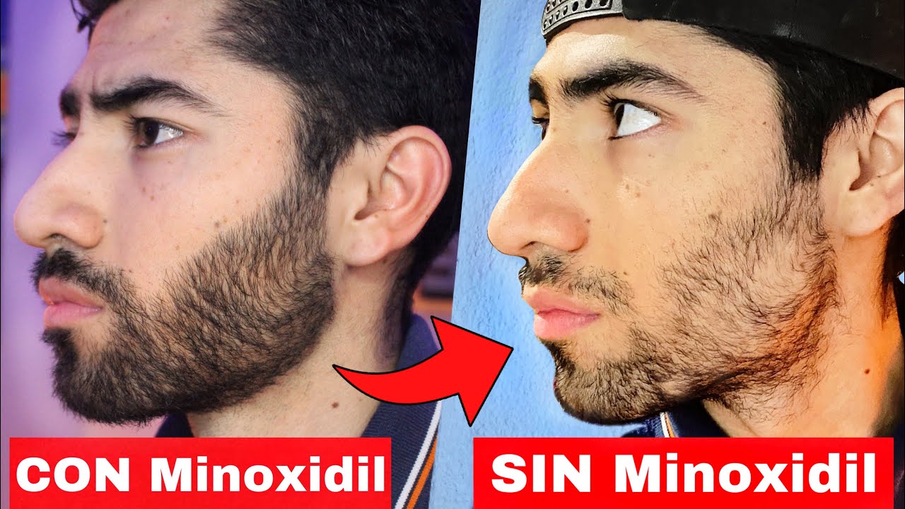 La VERDAD sobre DEJAR el Minoxidil - YouTube