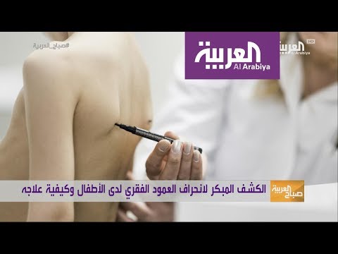 صباح العربية: انحراف العمود الفقري عند الأطفال وعلاجاته