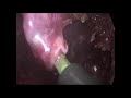 Laparoscopic Assisted Pullthrough for High Anorectal Malformation(Imperforated anus)